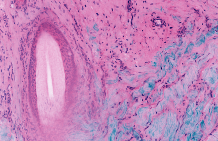 Better Results for Skin Cancer Surgery